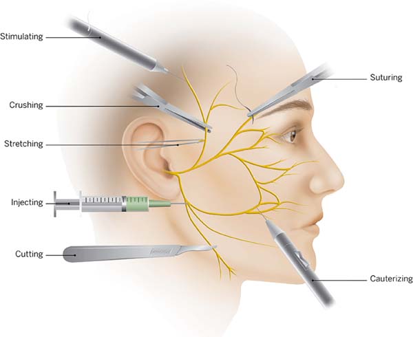 facial nerve palsy diagram