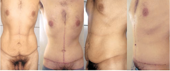 RBCP - Body contourning surgery after massive weight loss