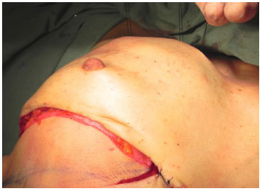 RBCP - Breast reconstruction with excess reverse abdominoplasty flap