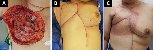 RBCP - Breast reconstruction with implant: creating a pocket with a reverse  serratus anterior muscle flap