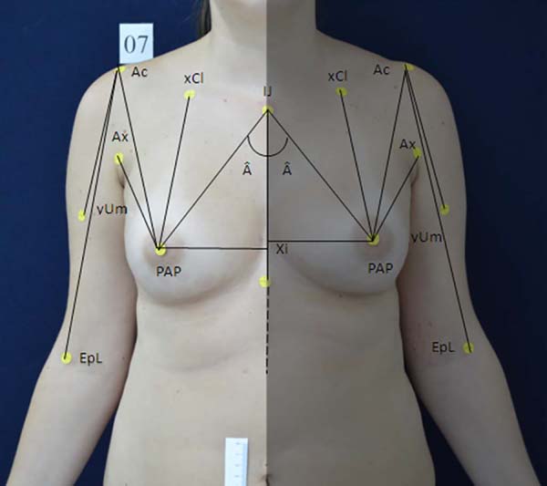 Vertical proportion of the anterior breast. H: a point where the