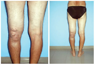 RBCP - Giant lipoma of the lower limb and its impact on the vascular system