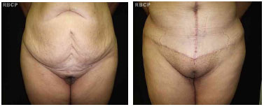 Mons Pubis Reduction Before & After Gallery: Patient 2