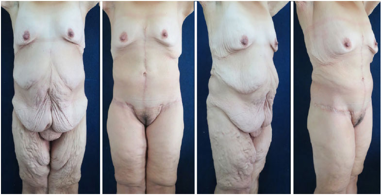 Awake Office Mons Liposuction & BodyTite (Scarless Monsplasty