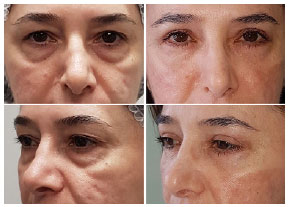 RBCP Blefaroplastia Inferior Reposicionamento Versus Ressec o Da 